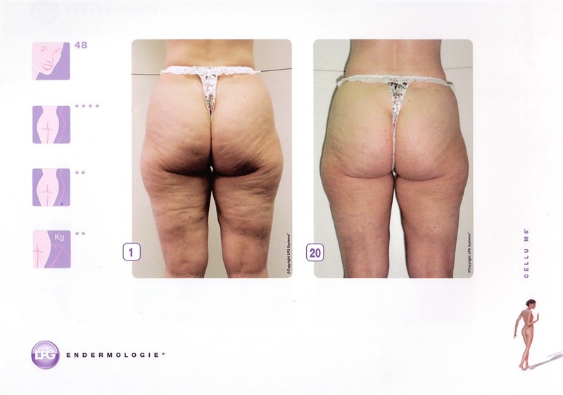 Endermologie2-Scanned.jpg